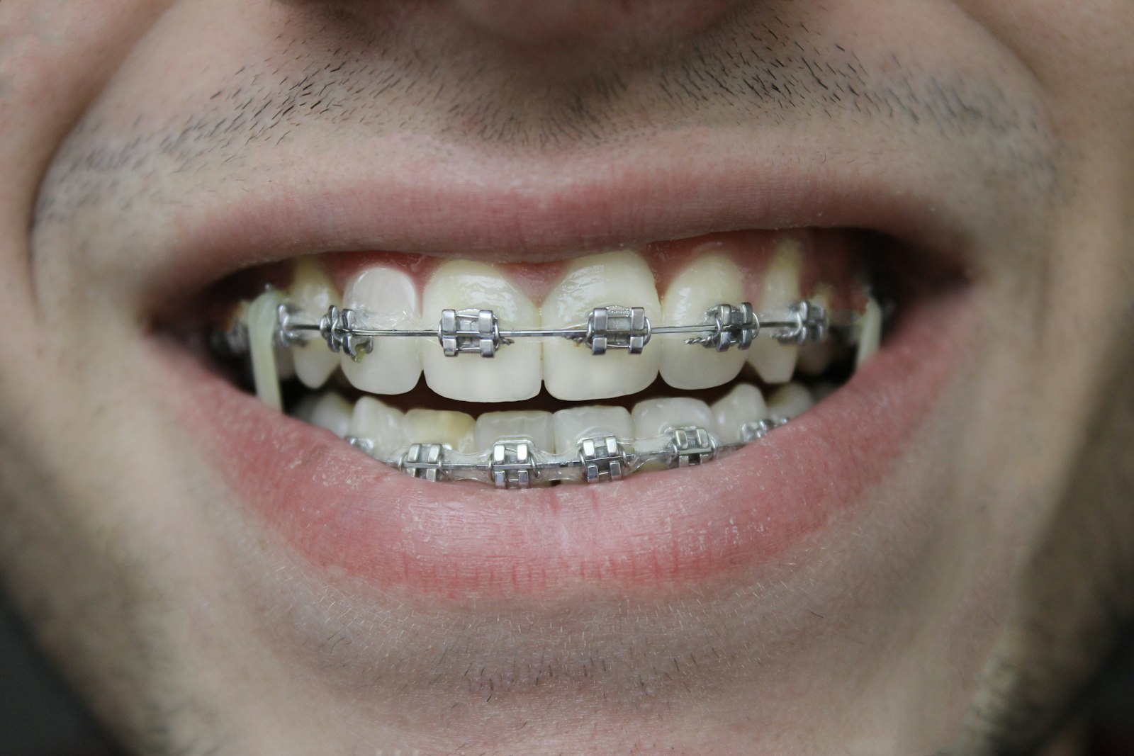 Close-up of upper and lower teeth fitted with metal orthodontic braces